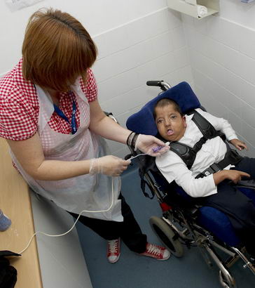 A boy being fed with a feeding
tube