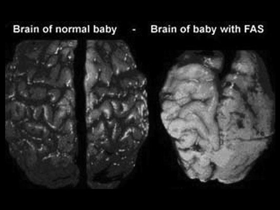 Brain of baby with FAS.